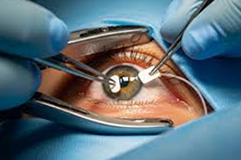 Dispositivo implantable de drenaje para el tratamiento de Glaucoma