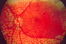 Functional diabetic retinopathy: A new concept to improve management of diabetic retinal diseases
